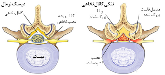 سوزش و ضعف رفتن ساق پا-4